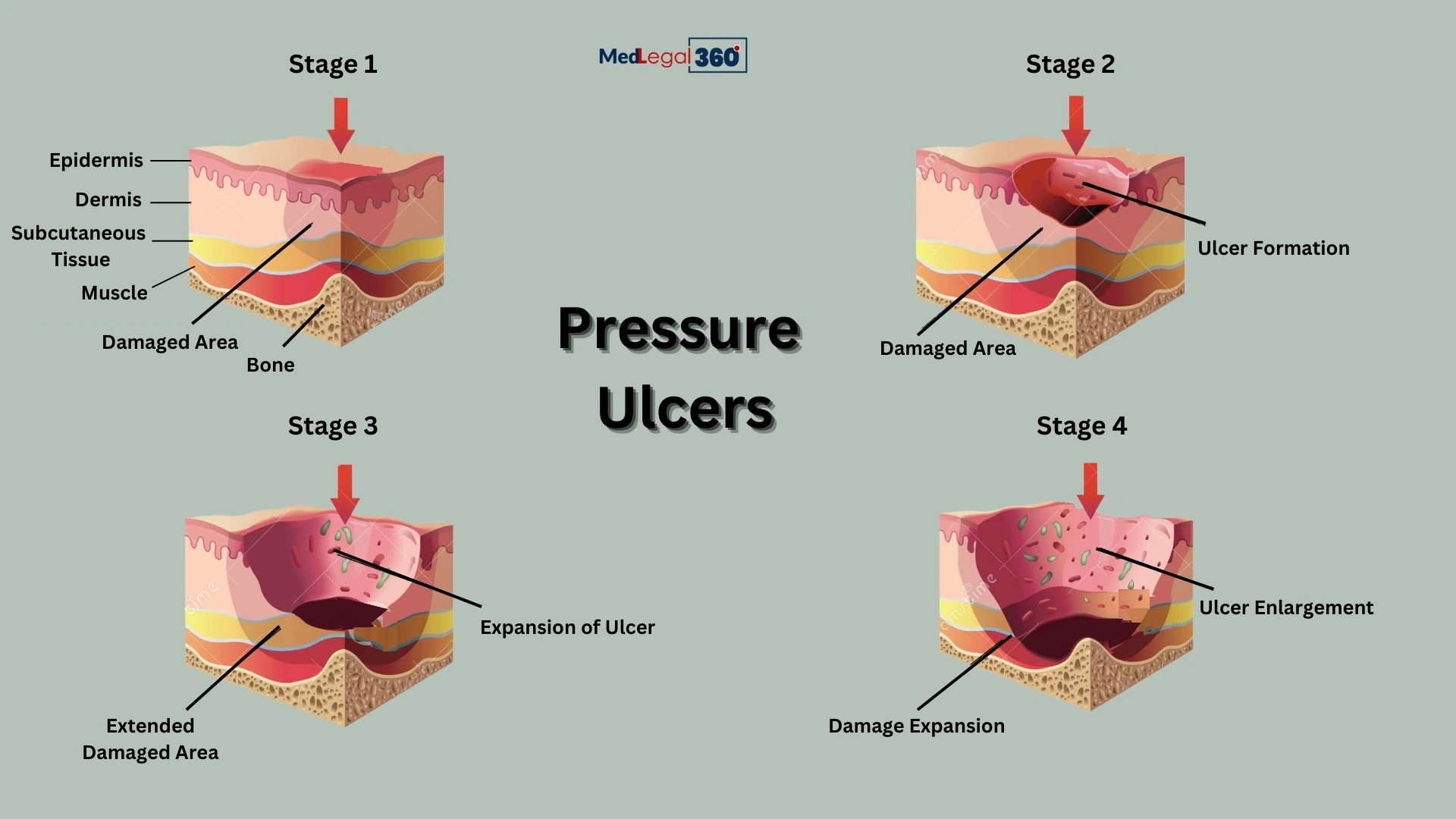 Pressure Ulcers And Bedsore Lawsuits A Closer Look