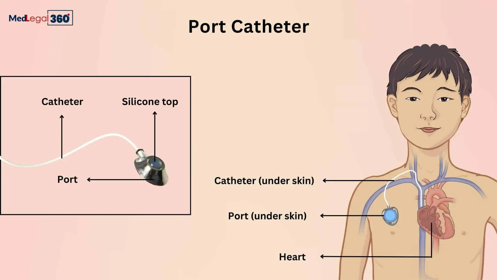 Port Catheter Lawsuit Updates 2025 Check Out Port Catheter Lawsuit Updates 2025 Check Out
